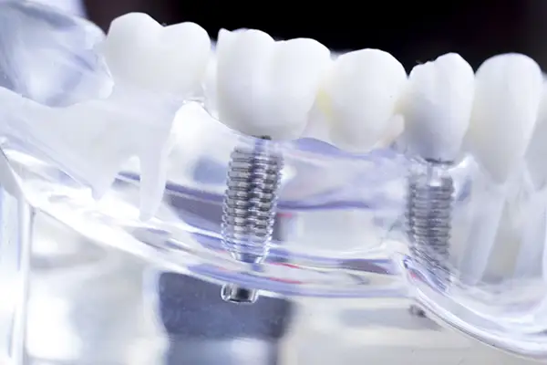 Implanty Wieliczka - Dlaczego implant?